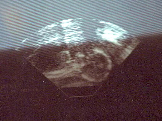 EmSonogram